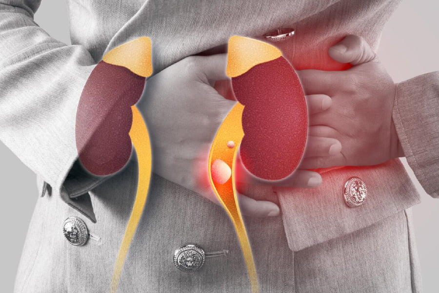 Cálculo renal tudo o que você precisa saber sobre esse problema muito